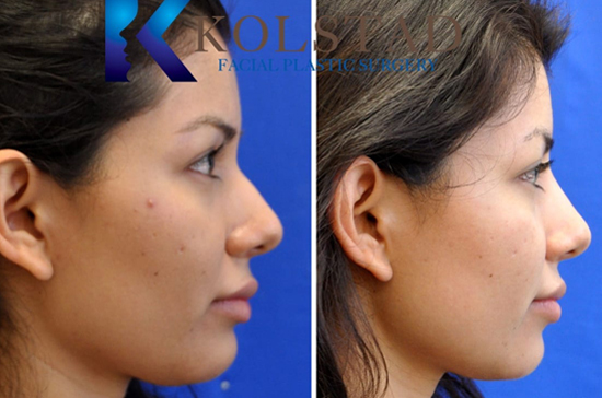 liquid rhinoplasty san diego del mar solana beach best filler injector facial plastic surgery results natural