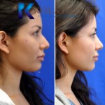 liquid rhinoplasty san diego del mar solana beach best filler injector facial plastic surgery results natural