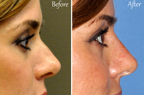 liquid rhinoplasty san diego la jolla del mar injectable filler nose job nonsurgical natural results