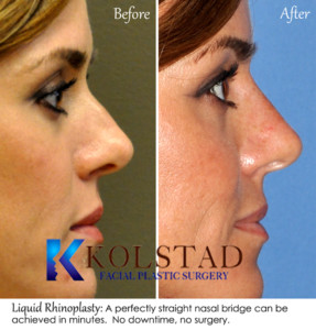 liquid rhinoplasty san diego la jolla del mar injectable filler nose job nonsurgical natural results