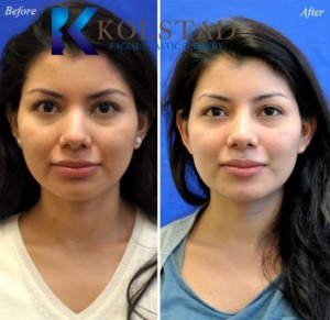 nonsurgical nose enhancement liquid rhinoplasty injectable hyaluronic acid filler juvederm san diego solana beach