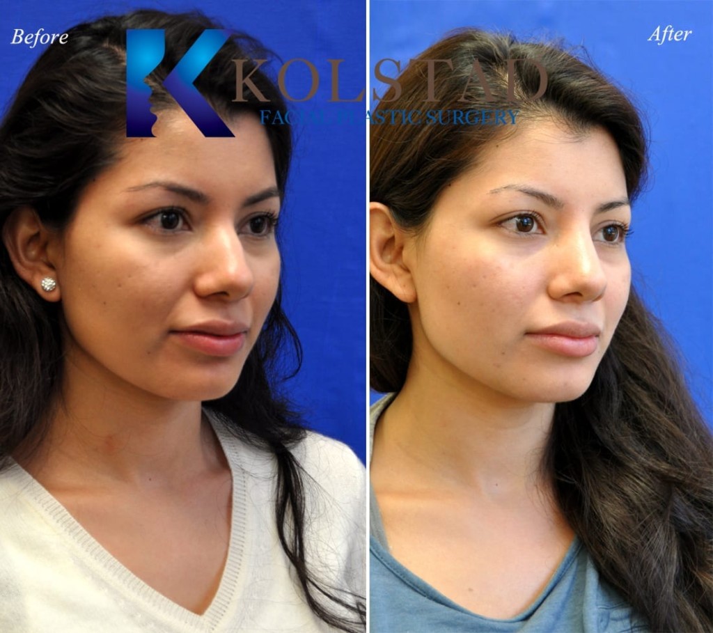 Best Non Surgical Rhinoplasty La Jolla Before & After Photos 8 Dr
