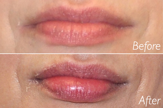permanent lip fillers la jolla san diego del mar si1000 top filler injector facial rejuvenation natural long lasting