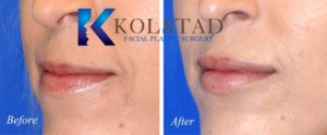 san diego carmel valley top lip injections thin lips fuller shape rejuvenation enhancement filler
