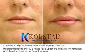 san diego la jolla restylane lip augmentation enhancement fuller bigger lips volume fillers injectables