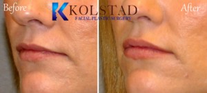 san diego lip augmentation best injectable fillers enhancement rejuvenation natural results juvederm