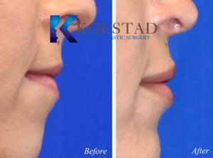 top lip filler injector expert san diego la jolla del mar best facial specialist best lips before after