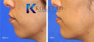Injectable chin filler