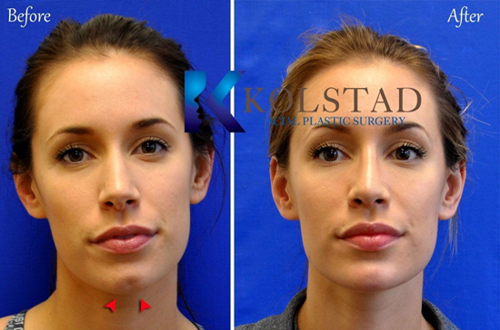 Injectable chin filler jawline recontouring natural results top doctor san diego la jolla del mar natural results