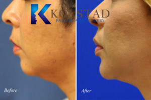 Chin filler and liposuction San Diego