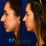 san diego before and after rhinoplasty