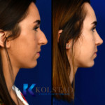rhinoplasty before and afters san diego