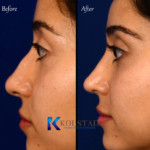 nose job middle eastern san diego