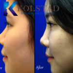 asian nonsurgical rhinoplasty results