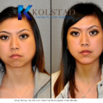 asian plastic surgery results