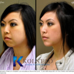 chin augmentation for asians