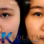 liquid rhinoplasty for asian before and after
