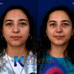 nose and chin surgery san diego