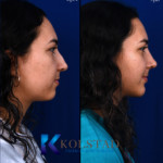 nose job and chin surgery san diego