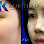 san diego asian rhinoplasty before and after