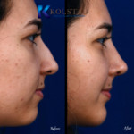 san diego nose job before and afters