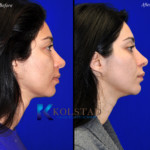 cosmetic eye surgery before and afters san diego