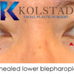 healed lower blepharoplasty incisions