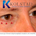 Close up lower blepharoplasty