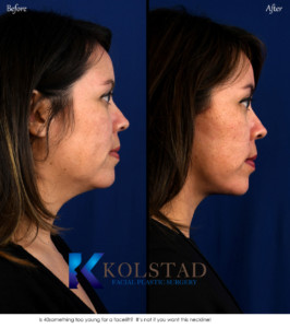 facelift before after