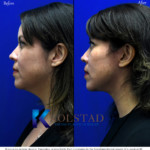 facelift before after
