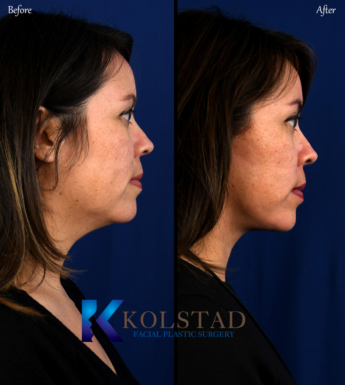 Deep plane facelift  Dr. Kolstad - San Diego Facial Plastic Surgeon