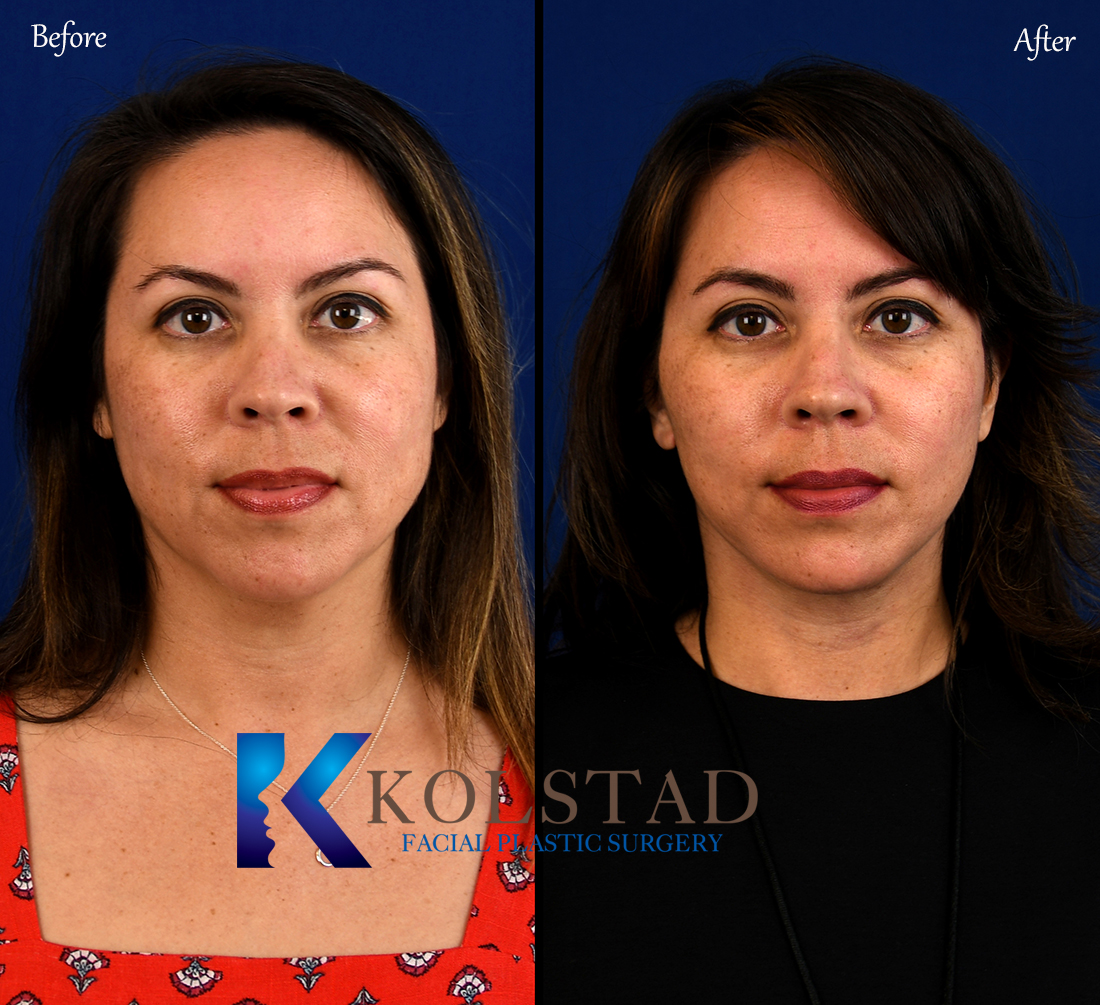 facelift before and after  Dr. Kolstad - San Diego Facial Plastic Surgeon