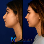 before and after middle eastern rhinoplasty