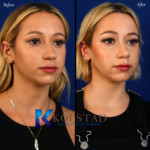 nose job surgical expert photos before and after