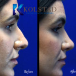rhinoplasty before and after la jolla dorsal hump removal