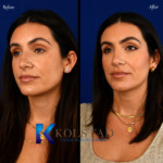rhinoplasty before and after san diego