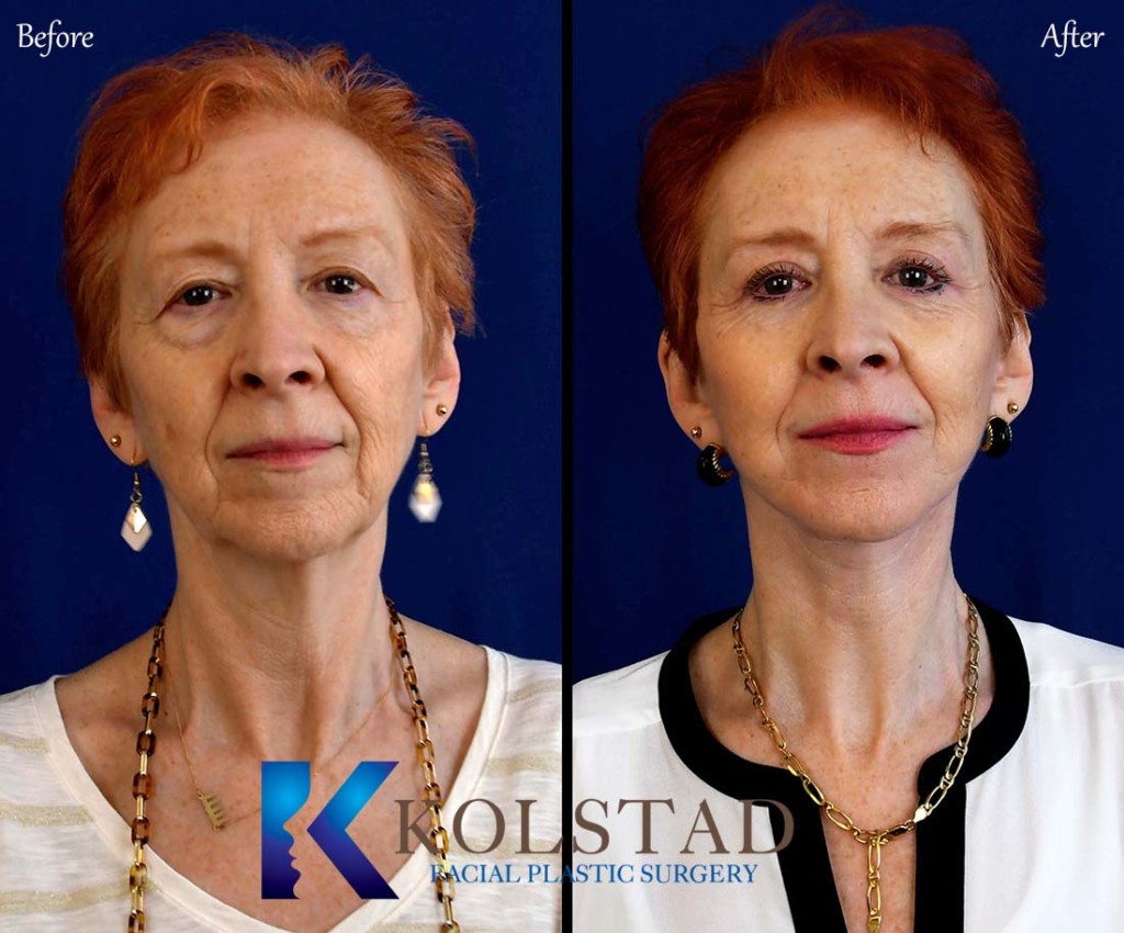 Facelift Before & After Gallery 2 Dr. Kolstad San Diego Facial
