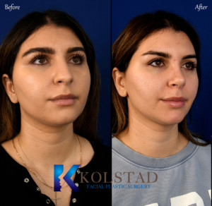 Natural Results with Middle Eastern Rhinoplasty