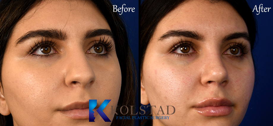 Facelift Before and After  Ranch & Coast Plastic Surgery