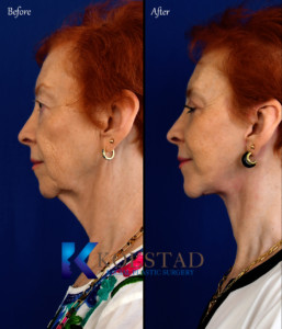 facelift san diego results