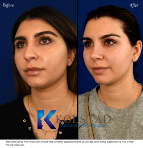 Personalized Nose Reshaping