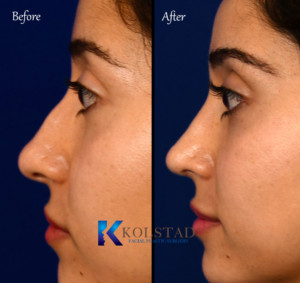 Natural-Looking Results through Hump Reduction