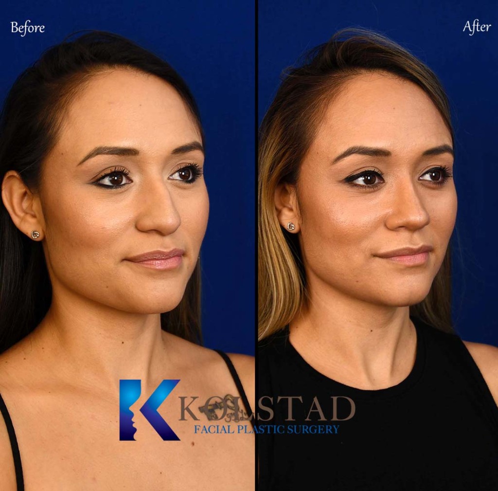 Nose Beauty Transformation Dr. Kolstad San Diego Facial Plastic Surgeon