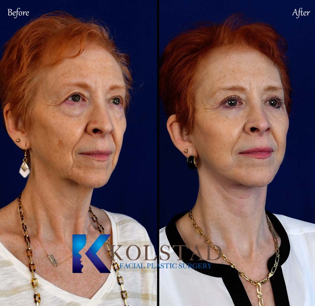 Facelift Before & After Gallery 2 Dr. Kolstad San Diego Facial