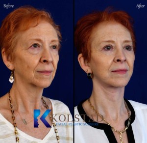 san diego face lift doctor