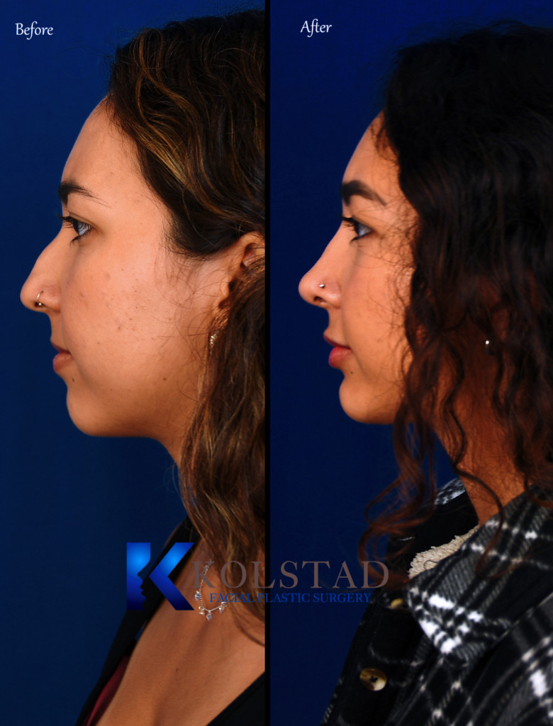 San Diego Nose Surgery Dr. Kolstad San Diego Facial Plastic Surgeon