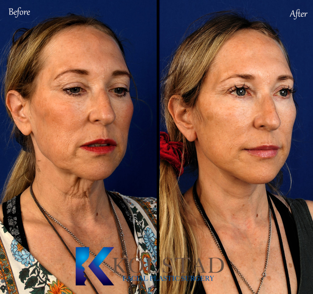Facelift Before & After Gallery 15 Dr. Kolstad San Diego Facial Plastic Surgeon