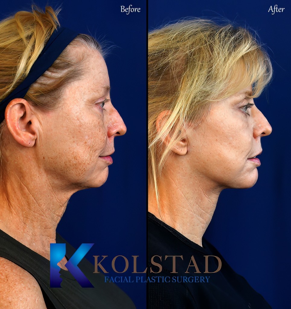Facelift Before & After Gallery 4 Dr. Kolstad San Diego Facial Plastic Surgeon