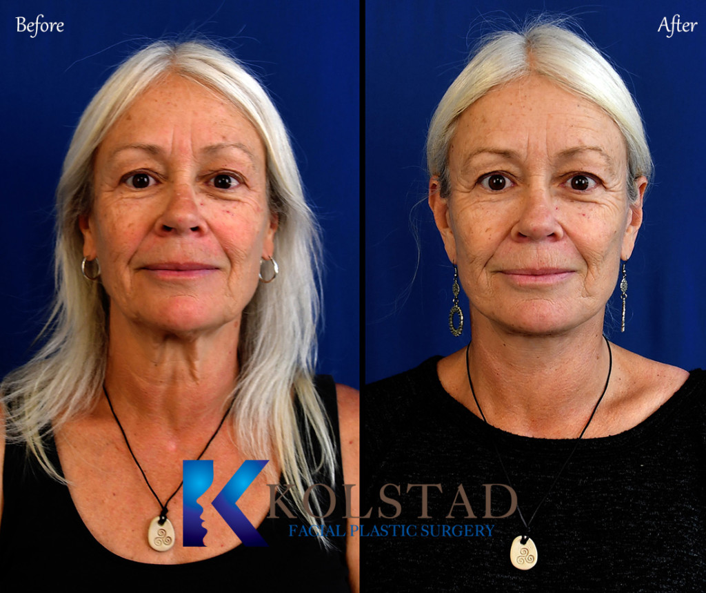 Facelift Before & After Gallery 16 Dr. Kolstad San Diego Facial