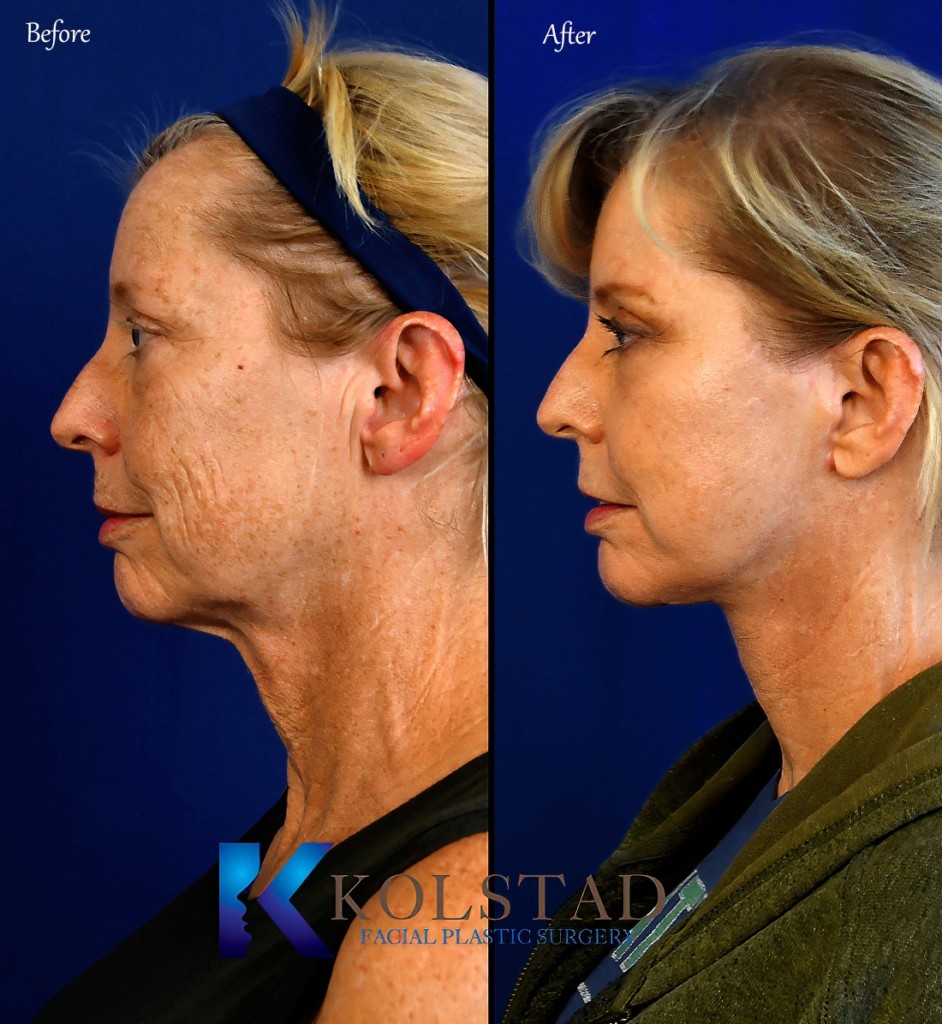 Facelift Before & After Gallery 4 Dr. Kolstad San Diego Facial